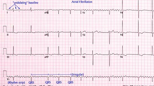  by many people is whether caffeine contributes to atrial fibrillation 