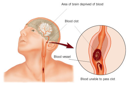 women heart attack symptoms. Signs amp; Symptoms of Stroke