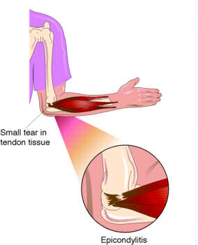 Arm Muscle Strain