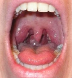 Small Tonsils